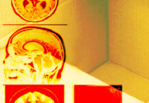Memory decline may be earliest sign of dementia