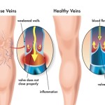 varicose vein image-rs